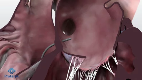 Protaryx Transseptal Puncture Device