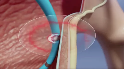 pulmonary hypertension denervation pulnovo medical
