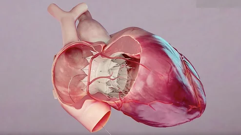 The U.S. Food and Drug Administration (FDA) has approved an investigational device exemption (IDE) to conduct a pivotal clinical trial for TRiCares Topaz transcatheter tricuspid valve replacement (TTVR) system in the U.S. The TTVR system uses two stent frames, one for the valve and one to engage the annulus with a membrane shirt between them to enable flexing of the outer ring to better seal against regurgitation.expansing stents 