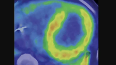 Cardiac amyloidosis on nuclear imaging of the heart using 11C-PiB PET/CT. Image courtesy of RSNA