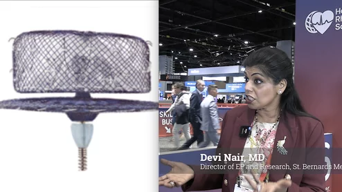 Devi Nair, MD, director of electrophysiology and research, St. Bernards Medical Center and Arrhythmia Research Group, explains how she uses concomitant left atrial appendage occlusion during EP procedures, and talks about new LAAO devices and ICE imaging.