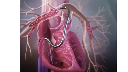 Jupiter Endovascular's Vertex Pulmonary Embolectomy System showed positive results in its SPIRARE II pivotal trial.