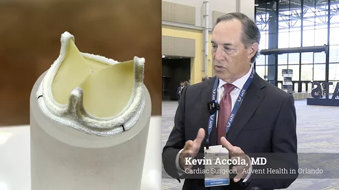 Kevin Accola, MD, a cardiac surgeon at Advent Health in Orlando, Florida, explains the 10-year results from the COMMENCE aortic trial that shows long-term durability and sustained performance of its Resilia surgical aortic valve. The data were presented at the American Association for Thoracic Surgery (AATS) 2026 annual meeting this week. #AATS #AATS26 #AATS2026