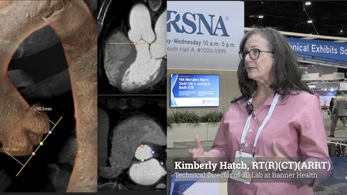 Kimberly Hatch, RT(R)(CT)(ARRT), technical director of 3D lab at Banner Health, explains the advances in advanced visualization software what is needed to build a comprehensive cardiac 3D imaging lab. 