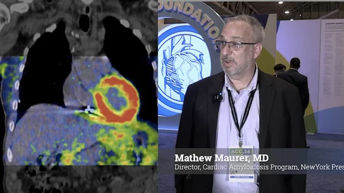 Video of Mathew S. Maurer, MD, director, Cardiac Amyloidosis Program, NewYork Presbyterian Hospital, explains how the American Hearty Association’s ATTR Amyloidosis Initiative is bringing together multidisciplinary teams to strengthen management of transthyretin amyloid cardiomyopathy (ATTR-CM). The goal is to catch more of these patients earlier and ensure they get timely care before they end up in advanced heart failure. #ATTR #Cardiacamyloidosis