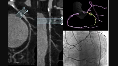 CCTA characterization of a chronic total occlusion with angiographic correlation during percutaneous coronary intervention.