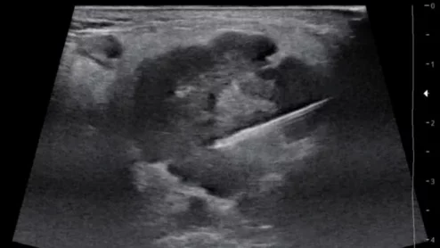New ultrasound needle yielded more substantial tissue samples