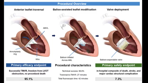 How BATMAN technique can reduce risk of LVOT obstruction during TMVR