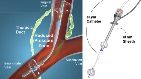 The WhiteSwell eLym catheter-based device for lymphatic drainage in acute decompensated heart failure (ADHF) patients.