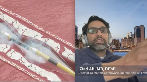 Ziad Ali, MD, DPhil, director of the DeMatteis Cardiovascular Institute, St. Francis Hospital and Heart Center, spoke with Cardiovascular Business about his center's experience using the recently released Johnson & Johnson MedTech next-generation Shockwave C2 Aero Coronary IVL Catheter to treat calcified coronary artery disease. Ali said his center was the first in the world to use the catheter in August 2025 and has since gained experience in roughly 80 cases.