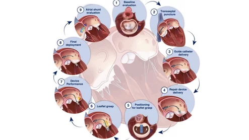 ASE guidelines summary of recommended imaging steps for performance of M-TEER.