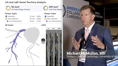Cardiologist Michael McMullan explains his surprise about high levels of soft coronary plaque seen on CCTA despite years of intensive statin therapy. #YesCCT