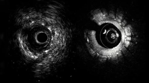 An example of the Novasight Hybrid System, showing its co-registered IVUS (left) and OCT intravascular imaging inside a coronary stent.