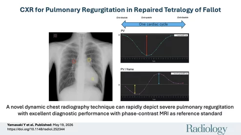 DDR dynamic cardiac X-ray for pulmonary valve regurgitation evaluation. Figure courtesy of RSNA