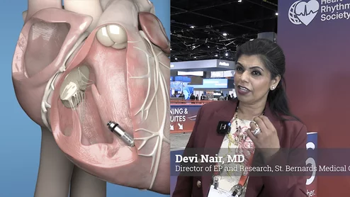 Devi Nair, MD, director of electrophysiology and research at St. Bernards Medical Center and the Arrhythmia Research Group, explains new technology advances in leadless pacing for conduction pacing and Bachmann's bundle pacing. 