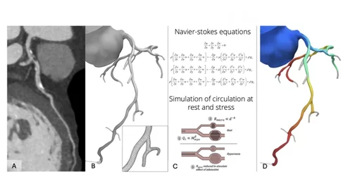 A figure from the new SCCT FFR-CT consensus document to help explain how the technology works to assess hemodynamic flow using CT imaging.