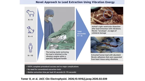This novel vibration-based extraction technique exhibited excellent safety and efficiency profiles in preclinical and initial human study, potentially offering a simple, rapid, and safe alternative to conventional extraction methods