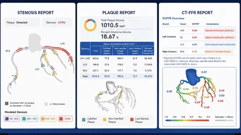 Keya medical's plaque analysis and FFR-CT reports generated from a single CT scan.