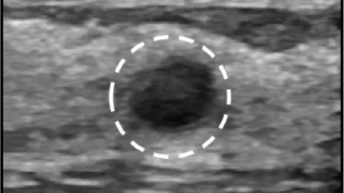 Portable ultrasound helps novice users accurately perform breast ultrasound