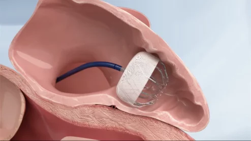 AnchorMan LAAC device MicroPort CardioFlow