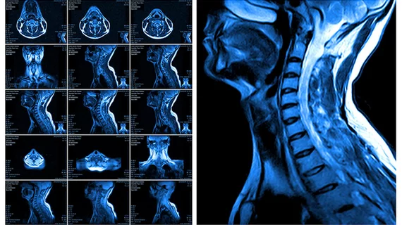 magnetic_resonance_imaging_of_the_cervical_spine.jpg