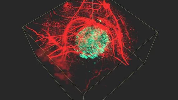 Photoacoustic tumor image