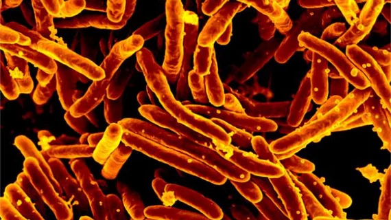 20180305-tuberculosis.jpg