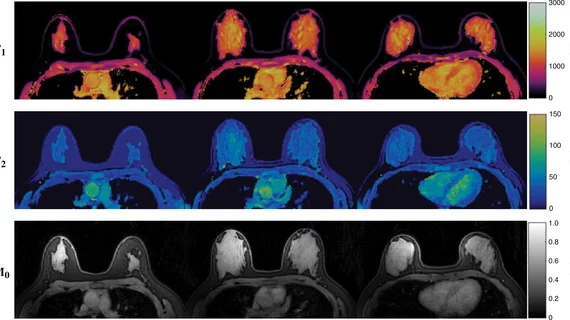 MR fingerprinting breast imaging