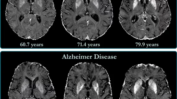 Alzheimer's