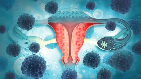 ovaries ovarian cancer