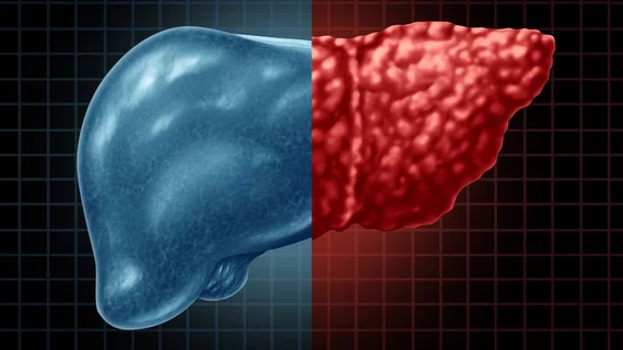 fatty liver disease hepatic steatosis 