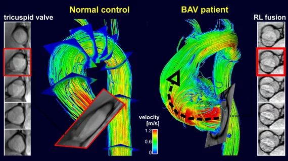 michael_markl_-_normal_vs_bav_flow_ppt_copy.jpg