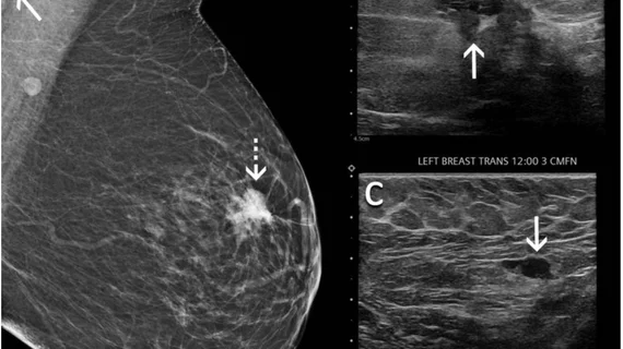 Don't delay mammograms after COVID vaccine. Women do not need to delay their mammogram appointment after COVID-19 vaccination. A new study suggests not delaying mammograms due to getting a COVID vaccine because cancers may go un detected. The RSNA study showed several examples of swollen lymph nodes that appeared to be from the vaccine, but turned out to be cancers. Women should not delay getting mammograms after COVID vaccines. Do not delay getting a mammogram with the COVID Vaccine. 