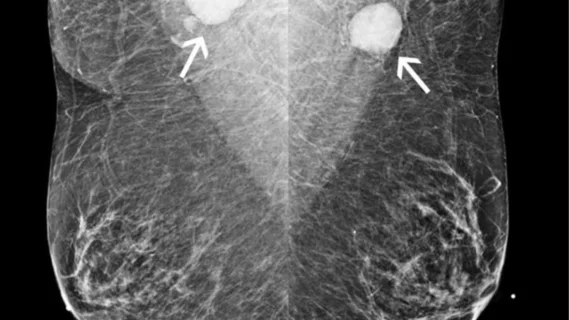 Don't delay mammograms after COVID vaccine. Women do not need to delay their mammogram appointment after COVID-19 vaccination. Women were told in 2021 to delay breast imaging if they got the COVID-19 vaccination because it can cause lymph node swelling and upper as cancer. A new RSNA study suggests not delaying mammograms because some women are presenting with cancer and they should not delay screening. Do not wait to get a mammogram after having a COVID vaccination.