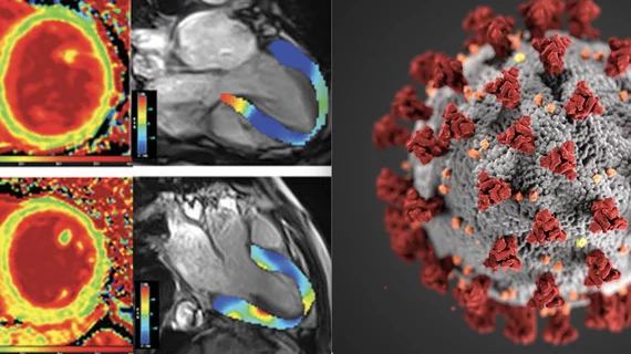 covid_myocarditis_rsna_cdc_images.jpg