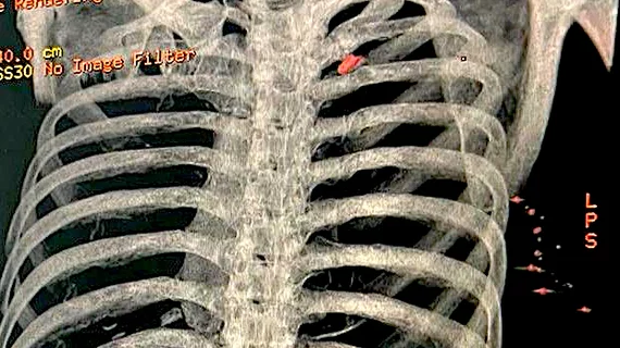 A CT image from the Heart Institute in Kyiv, Ukraine, showing a Russian bullet in a civilian patient's upper lung lobe. The patient was being treated at the cardiology hospital after he tried to drive his family out of the area of the front lines and was shot at by Russian soldiers. He is being treated by cardiac surgeon Igor Mokryk MD. Photo by Igor Mokryk. 