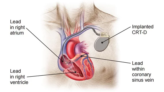 Cardiac resynchronization therapy with a defibrillator (CRT-D) can be used to significantly improve mortality and hospitalization rates among older heart failure patients. CRT-D illustration courtesy of Boston Scientific.