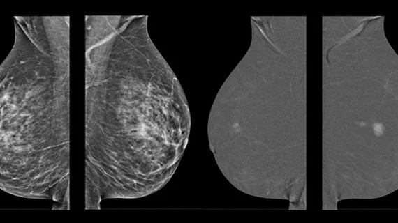 The FDA tracks mammography systems and the number of exams performed in the U.S. through its Mammography Quality Standards Act (MQSA) program. This is an example of the GE Senobright HD imaging system.