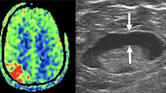 Two top stories radiology this past month was the nuclear imaging isotope shortage and an ultrasound imaging study of COVID vaccine adenopathy.