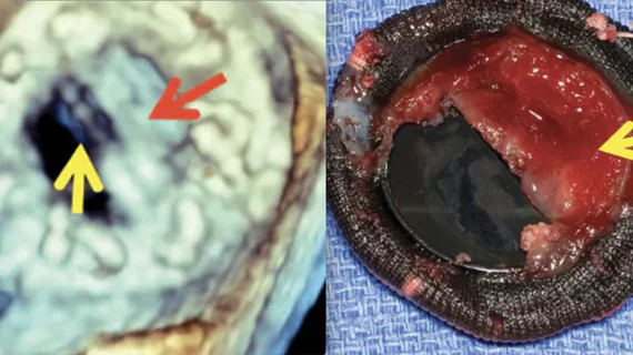 Examples of prosthetic heart valve thrombus formation on the valve leaflets. A new study shows better outcomes using tPA vs. surgery to remove the clots. Valve thrombosis. Images from Mayo Clinic