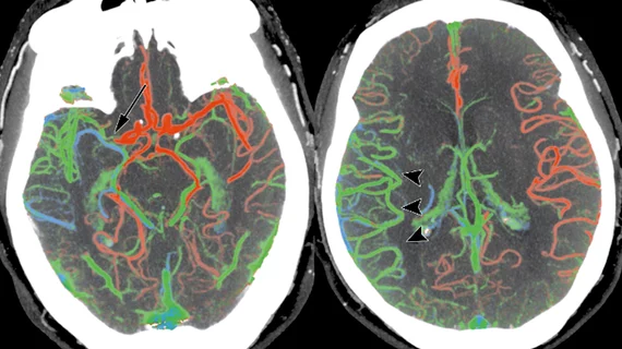 Ischemic stroke CT scan showing color coded blood flow for early and later arterial and venous contrast phases and areas of blocked blood flow. Image courtesy of RSNA