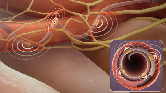 The Medtronic Symplicity Spyral Renal Denervation system uses a catheter that curls in the renal artery to place radiofrequency electrodes against the vessel wall to ablate the nerves that control vasodilation, so the artery can be propped in the fully open position.