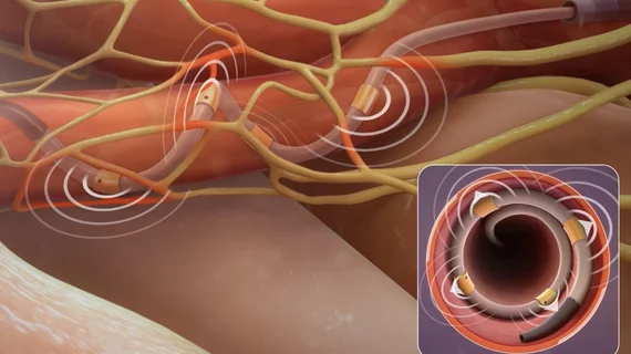 The Medtronic Symplicity Spyral Renal Denervation system uses a catheter that curls in the renal artery to place radiofrequency electrodes against the vessel wall to ablate the nerves that control vasodilation, so the artery can be propped in the fully open position.