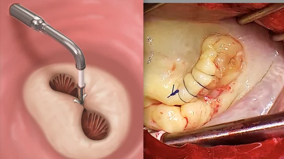 MitraClip vs mitral valve edge to edge repair (TEER).