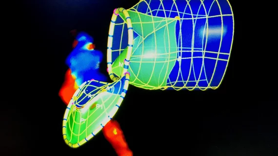A view showing the close relationship between the mitral and aortic valves and how the overhang of a longer TAVR valve in the left ventricular outflow tract (LVOT) may cause friction near the mitral valve. Image from a mitral echo assessment using Siemens eSie Valves software at ACC22.