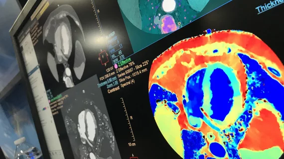 A spectral CT image of the heart showing ischemia in the myocardium by mapping the iodine density in the tissues as a surrogate for bloodflow. Example is from Philips Healthcare, displayed at the 2022 ACC meeting. Example of cardiac perfusion imaging. #SCCT