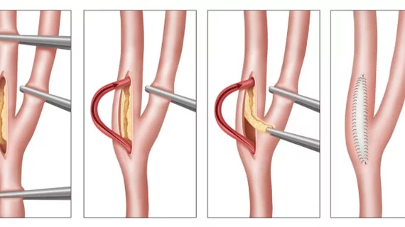 Carotid endarterectomy (CEA) is not associated with a significant reduction in the risk of dementia, according to a new analysis published in the European Journal of Vascular & Endovascular Surgery.[1] However, the study’s authors noted, it did still lead to considerable improvements in stroke risk. 