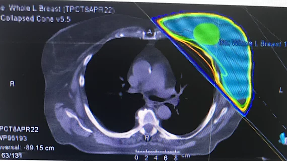 A CT scan used for a radiation therapy treatment plan for breast cancer shiows the close proximity of the heart, which can suffer collateral damage from radiation and chemotherapy treatments for cancer. 