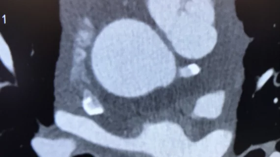 Cardiac CT imaging has been moved to the forefront of medical imaging to evaluate chest pain under the new 2021 chest pain guidelines from the AHA and ACC. #Yescct #CCTA #CTA #CT