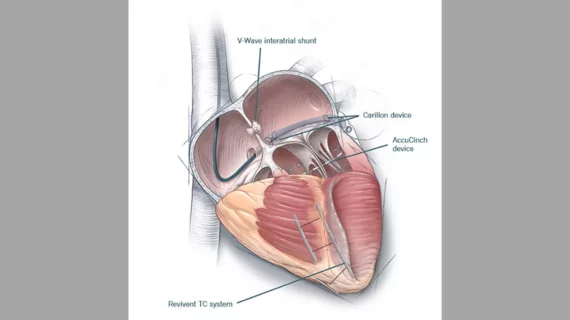 Illustration showing four innovative heart failure technologies: The V-Wave interaterial shunt to relieve pressures between the left and right sides of the heart; the Carillon Transcatheter mitral valve annuloplasty system; the Revivent TC system and the AccuCinch device. Interventional cardiology heart failure cleveland clinic 